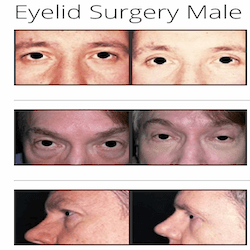 Eyelid Surgery