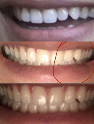 fixed tooth