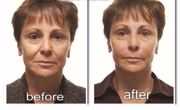 Radiesse is the best filler to improve the cheeks and nasolabial folds.