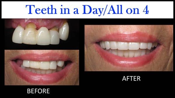 Actual patient. Teeth in a Day / All on 4 patient upper jaw only.  Before and After Results