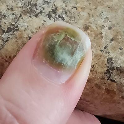 Horrible nail fungus!