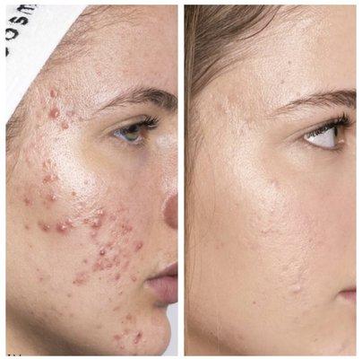 Acne series Before &After