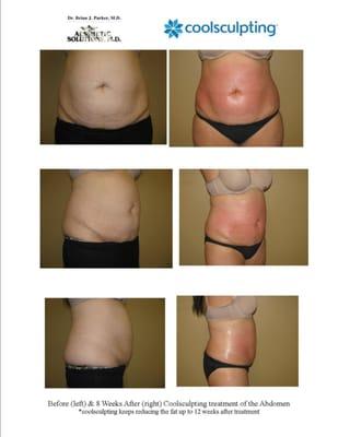 Coolsculpting Before & After Pictures
http://lvplasticsurgery.com/