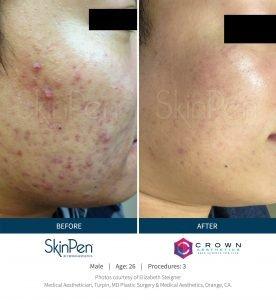 Microneedling with the SkinPen offered here. Try with PRP for our Vampire Facial treatment!