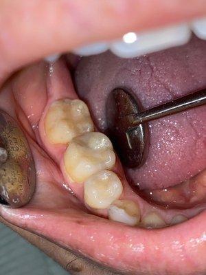 Aftermath (pretty porcelain fillings) Fixed Tooth - by Dr. Gary Gwilt