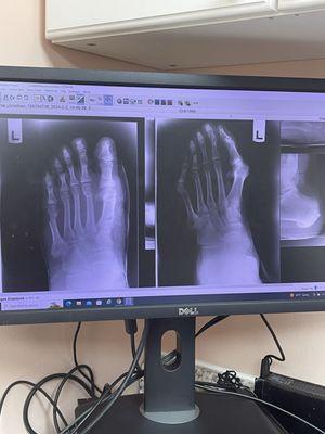 This is a before (right) and after (left) picture of my bunion removal.