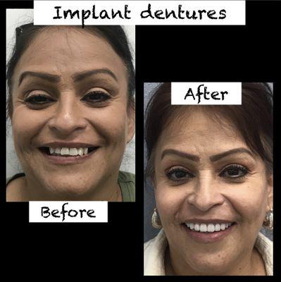 Full mouth upper and lower implant dentures