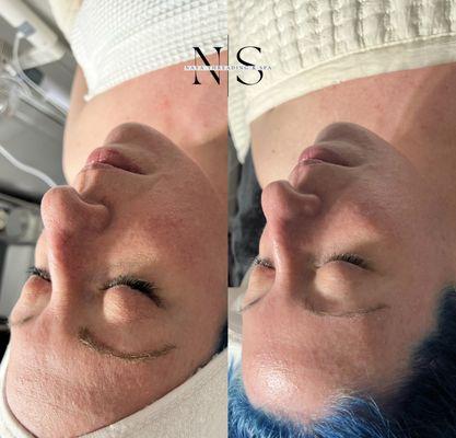 Customized facial before and after