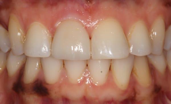 After Photo - Improving the color of a tooth using new materials in dentistry