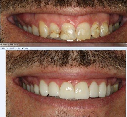 Signature Veneers by Dr. Davoodi