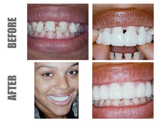 Snap On Smile!  A removable solution to creating a perfect smile on a lower budget!