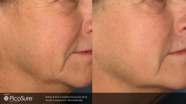 The PicoSure laser removes unwanted pigment, treat wrinkles and acne scars with discomfort or downtime.