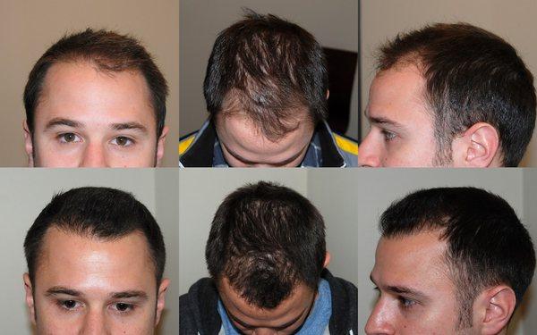 Before and After Hair Restoration Procedure