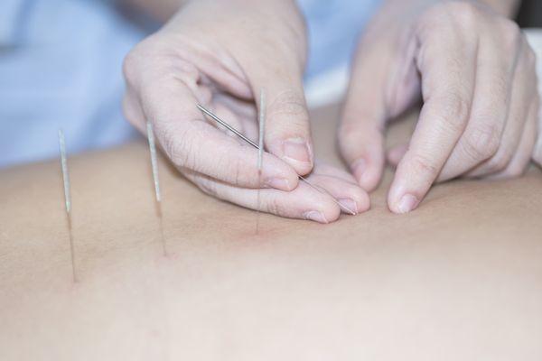 Acupuncture in Glendora