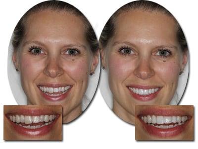 EasySmile Veneers Before and After....1 visit, no shots, no removal of healthy tooth structure, very affordable!