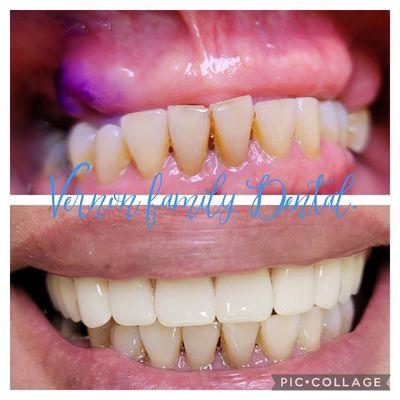 Upper flexible partial denture with no metal. A nice and natural smile is a valuable asset and can greatly enhance one's appearance.