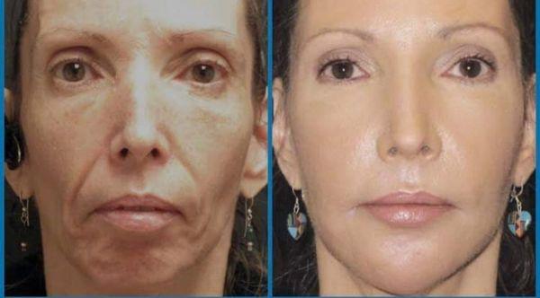 Before and after Bellafill "liquid facelift."