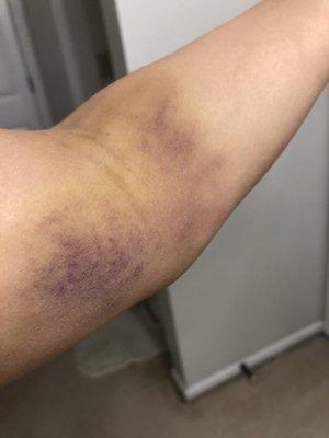 Aftermath of a routine blood work