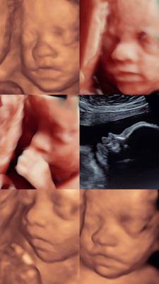 3D/HD Live Ultrasound Images from Baby Bound Ultrasound