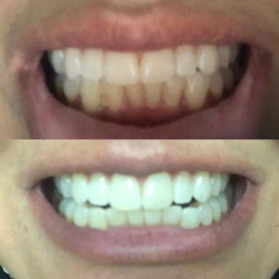 Before and after whitening $50