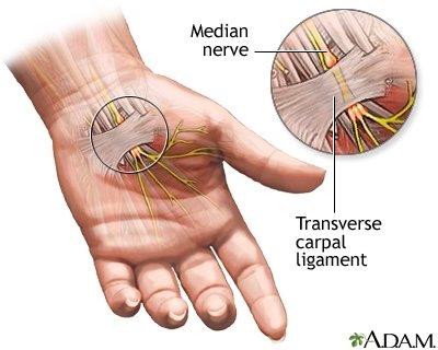 Massage therapy for carpal tunnel syndrome