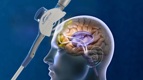 Transcranial Magnetic Stimulation: a non-drug treatment for clinical depression. It uses magnetic pulses to stimulate nerve cells.