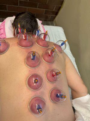 Cupping