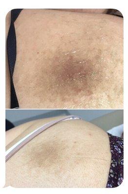 Before and after 2 sessions of IPL treatment for hyperpigmentation