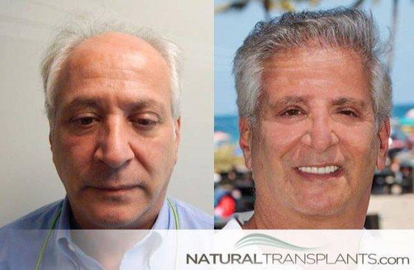 Don't go to a Robotic Hair Transplant Clinic in Florida.