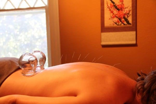 Acupuncture with Cupping