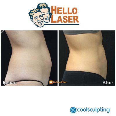 CoolSculpting results showing non invasive fat reduction of the abdomen stomach area.