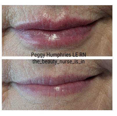 Lip Filler to enhance and restore shape and volume