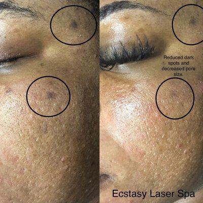 Laser Rejuvenation