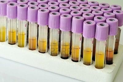 Hematology blood test