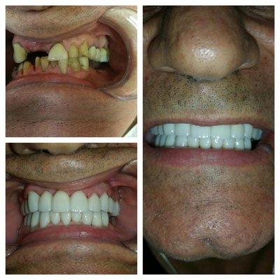 Full mouth rehabilitation. Pt was very happy with results.