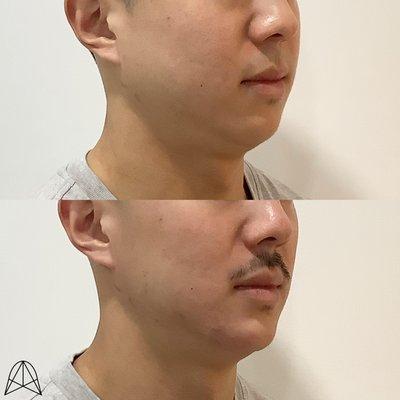 Jawline enhancement