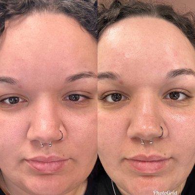 Before and after UPNEEQ eye drops and facial!!! My skin is so revived and my eyes are wide open!!!