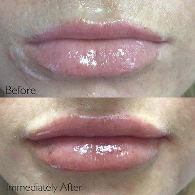 Lip augmentation with Restylane, Top is before, Bottom is Immediately post procedure.