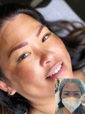 Brow Correction