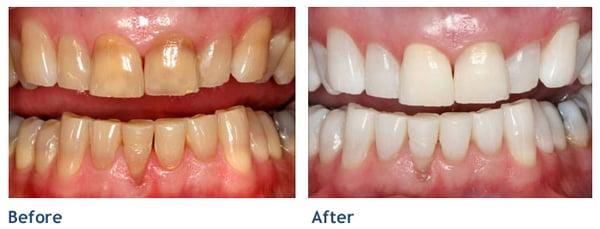 KOR Teeth Whitening. #cosmeticdentistnyc