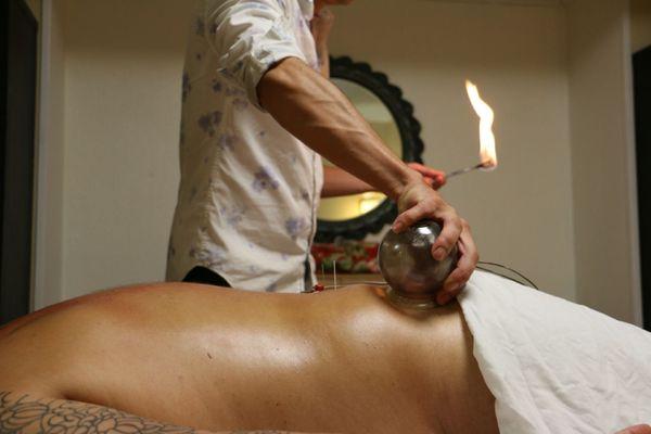 Fire cupping therapy