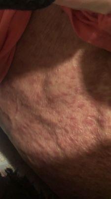 These are bites from the scabies on my moms back and stomach.