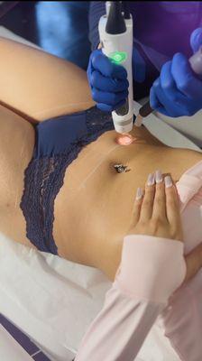 Bikini Laser Hair Removal pain- free with air technology