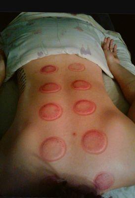 Cupping