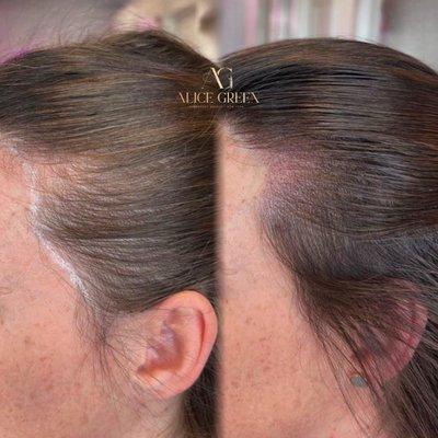 Scalp micropigmentation for temples area