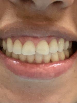 I had a chipped tooth after my braces were removed. Dr. Honda fixed it. I was amazed by the results. Thank you so much Doctor.