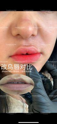 Lip neutralization