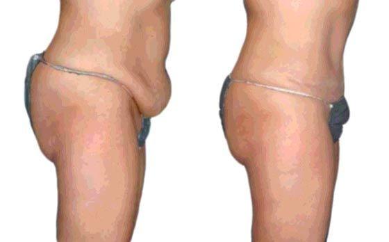 Also known as abdominoplasty, a tummy tuck removes excess fat and skin, and in most cases restores weakened or separated muscles