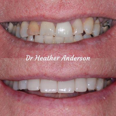 Our patient wanted to improve his smile. Dr Heather Anderson placed four porcelain crowns and several composite restorations.