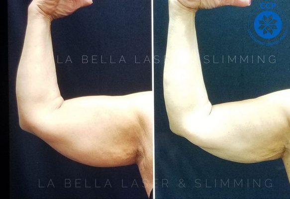 5 weeks after only 1 CoolSculpting treatment of the upper arms!